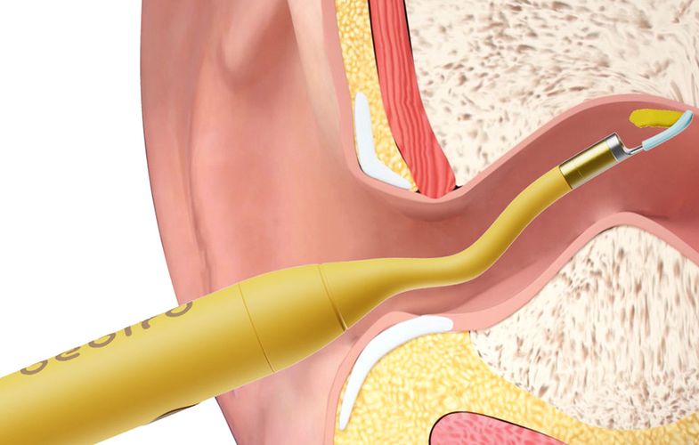 Otoscope with ear cleaning camera Bebird D3 PRO (yellow), Bebird Bebird D3 PRO