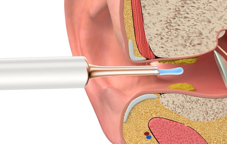 Smart Visual Ear-Clean Rod Bebird T15 white, Bebird Bebird T15