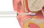 Smart Visual Ear-Clean Rod Bebird T15 white, Bebird Bebird T15